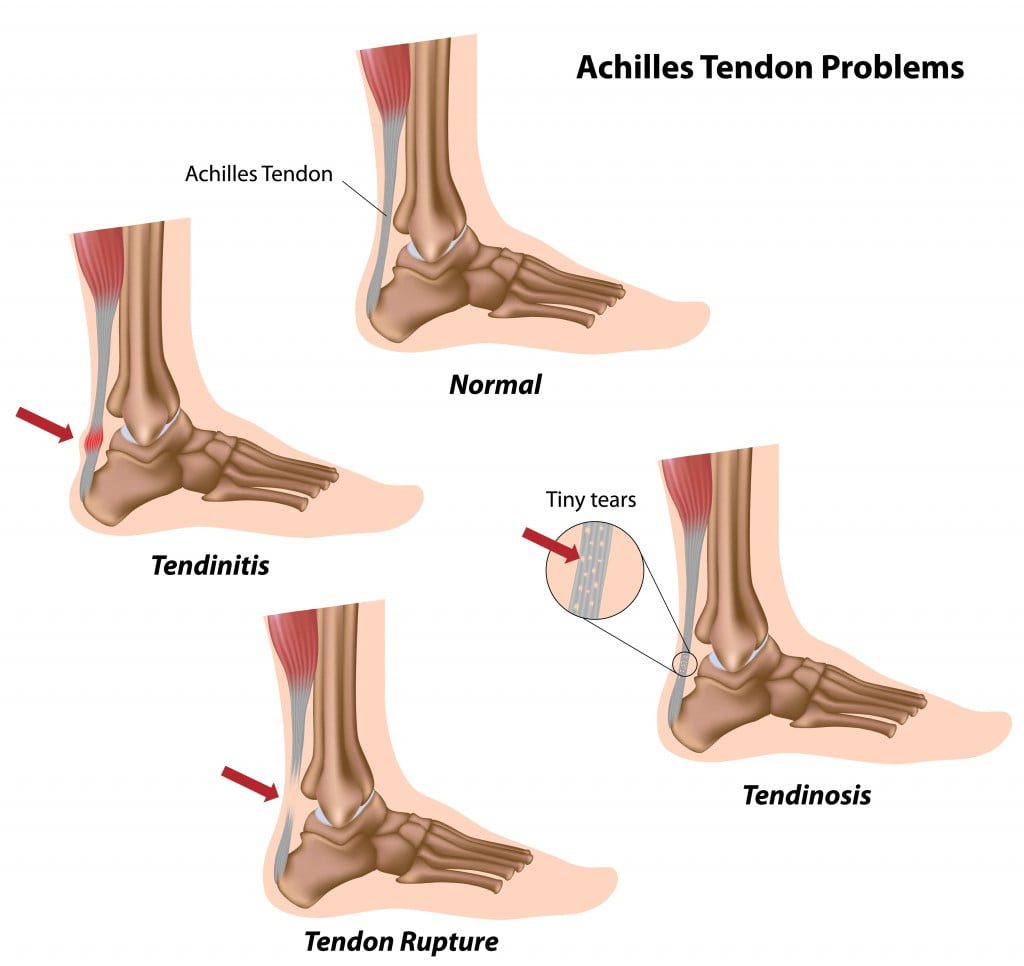 Achilles Tendinitis Treatment at Ortho Design