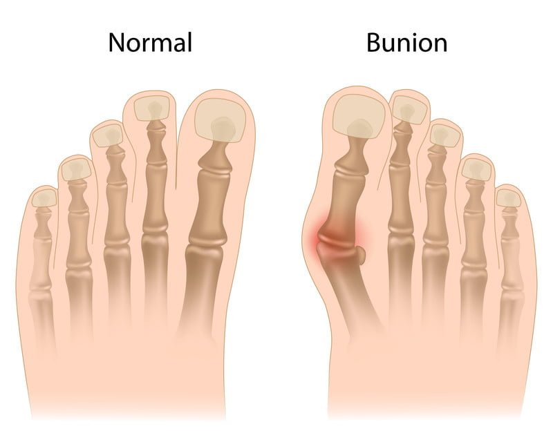 Bunion Treatment at Ortho Design