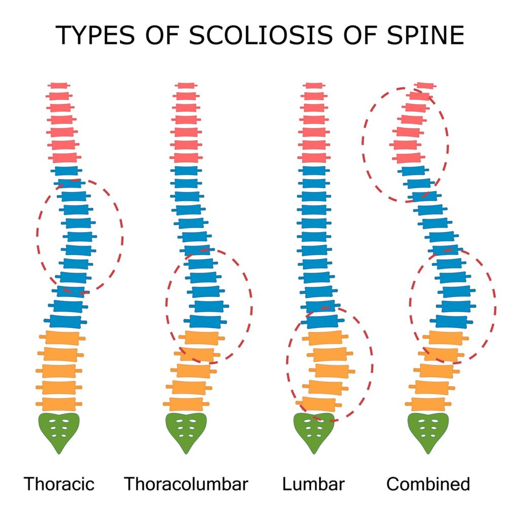 Scoliosis Orthoses scoliosis types
